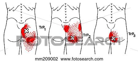 Gluteus maximus m., trigger points View Large Illustration Drawing - Gluteus maximus m., trigger points. Fotosearch