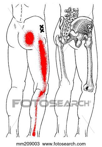 Drawing - Gluteus minimus, trigger points. Fotosearch