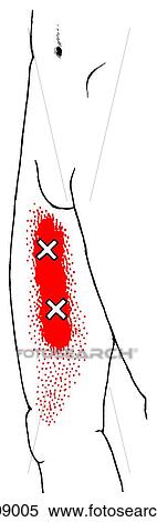 Gracilis m., trigger points View Large Illustration Stock Illustration - Gracilis m., trigger points. Fotosearch
