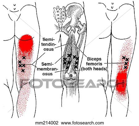 Hamstring m., trigger points View Large Illustration Drawing - Hamstring m., trigger points. Fotosearch
