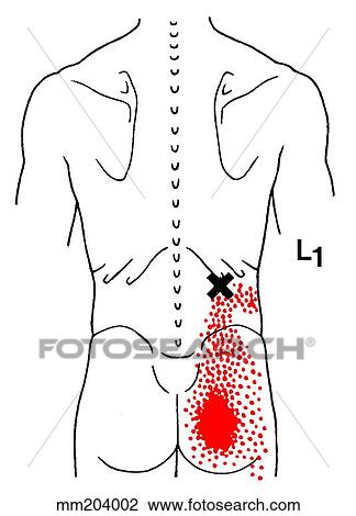 Iliocostalis lumborum m., trigger points View Large Illustration Drawing - Iliocostalis lumborum m., trigger points. Fotosearch