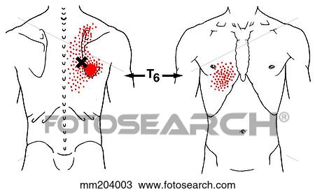 Iliocostalis thoracis m., trigger points View Large Illustration Drawing - Iliocostalis thoracis m., trigger points. Fotosearch