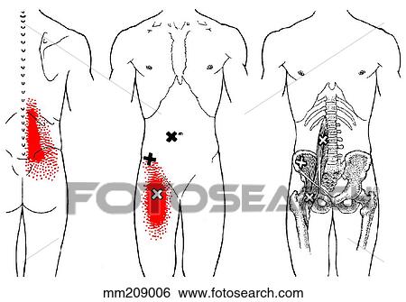 Stock Illustration - Iliopsoas m., trigger points. Fotosearch