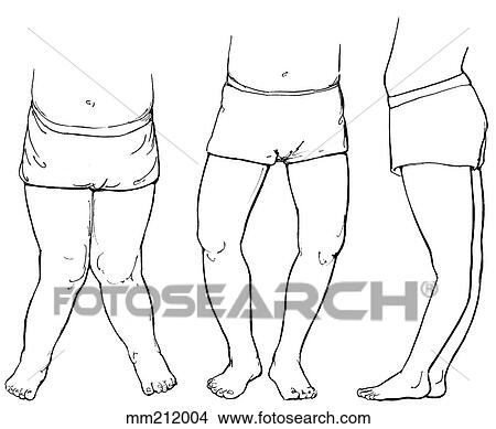 Knee deformities View Large Illustration Stock Illustration - Knee deformities. Fotosearch