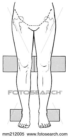 Knees, ideal alignment View Large Illustration Stock Illustration - Knees, ideal alignment. Fotosearch
