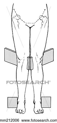 Stock Illustration - Knock-knees, postural. Fotosearch