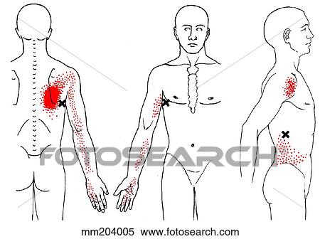Stock Illustration - Latissimus dorsi m., trigger points. Fotosearch
