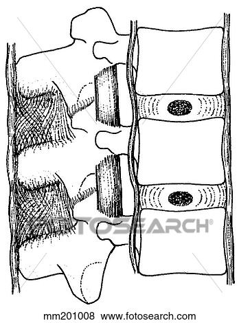 Stock Illustration - Ligaments, spinal. Fotosearch