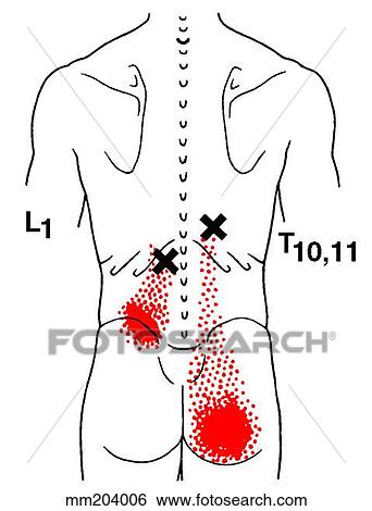 Longissimus thoracis m., trigger points View Large Illustration Stock Illustration - Longissimus thoracis m., trigger points. Fotosearch