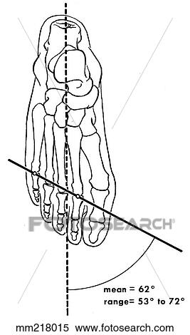 Metatarsal head angle View Large Illustration Stock Illustration - Metatarsal head angle. Fotosearch