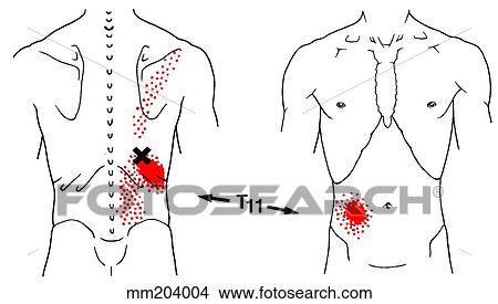 Drawings of Iliocostalis thoracis m., trigger points mm204004 - Search ...