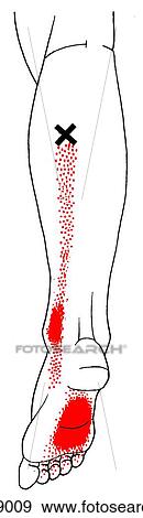 Stock Illustration of Flexor digitorum longus m, trigger points ...