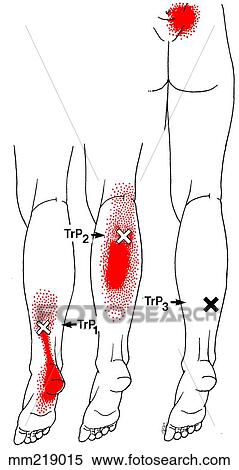 Stock Illustration of Soleus m., trigger points mm219015 - Search ...