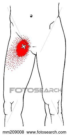 Pectineus m., trigger points View Large Illustration Stock Illustration - Pectineus m., trigger points. Fotosearch