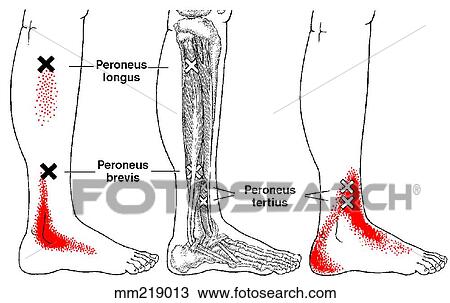 Drawing - Peroneal muscles, trigger points. Fotosearch