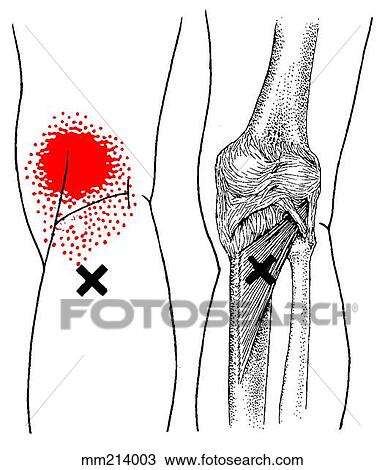 Popliteus m., trigger points View Large Illustration Drawing - Popliteus m., trigger points. Fotosearch