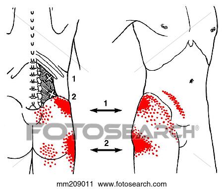 Quadratus lumborum m., trigger points View Large Illustration Clip Art - Quadratus lumborum m., trigger points. Fotosearch