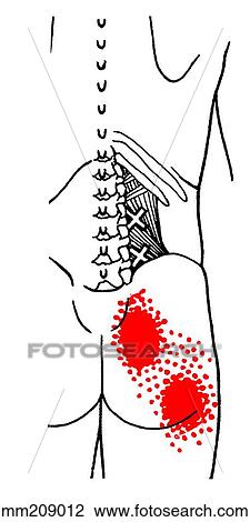 Drawing - Quadratus lumborum m., trigger points. Fotosearch