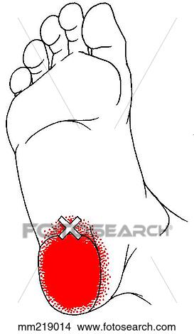 Quadratus plantae m., trigger points View Large Illustration Stock Illustration - Quadratus plantae m., trigger points. Fotosearch