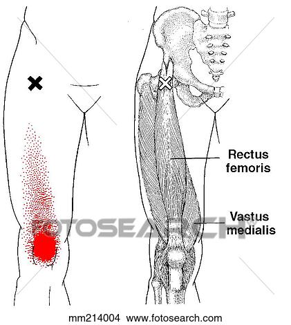 Rectus femoris m., trigger points View Large Illustration Stock Illustration - Rectus femoris m., trigger points. Fotosearch