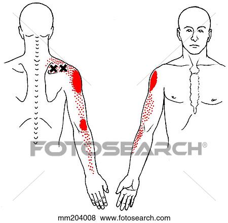Supraspinatus m., trigger points View Large Illustration Stock Illustration - Supraspinatus m., trigger points. Fotosearch