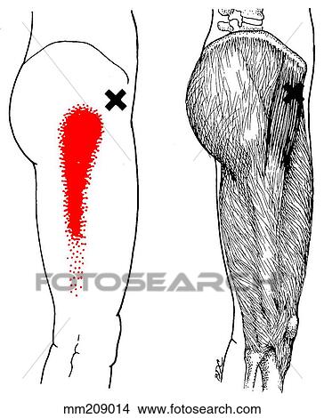 Stock Illustration - Tensor fasciae latae m., trigger points. Fotosearch