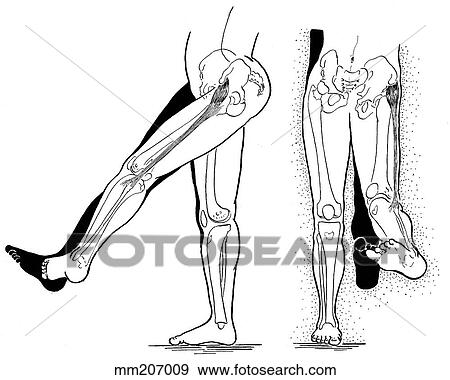 Stock Illustration - Tensor fasciae latae, shortened. Fotosearch