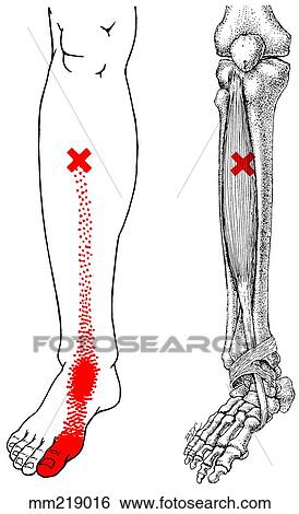 Tibialis anterior m., trigger points Stock Illustration | mm219016