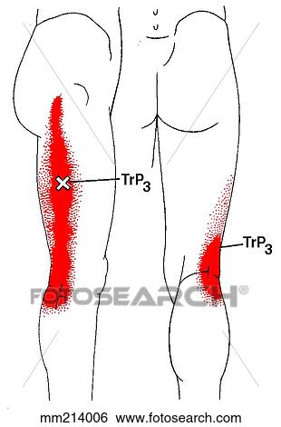 Stock Illustration of Vastus lateralis m., trigger points mm214006 ...