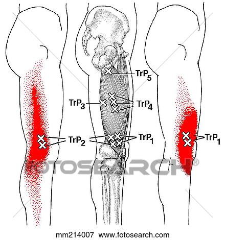Vastus lateralis m., trigger points View Large Illustration Stock Illustration - Vastus lateralis m., trigger points. Fotosearch