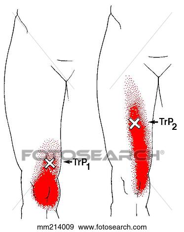 Vastus medialis m., trigger points View Large Illustration Stock Illustration - Vastus medialis m., trigger points. Fotosearch