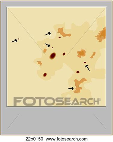 Clipart - walker test-positive. Fotosearch
