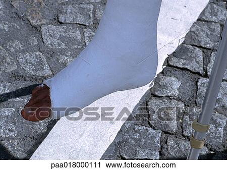 Foot in cast, close up of foot. View Large Photo Image Stock Image - Foot in cast, close up of foot.. Fotosearch