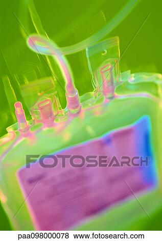 IV drip bag, close-up View Large Photo Image Stock Photo - IV drip bag, close-up. Fotosearch