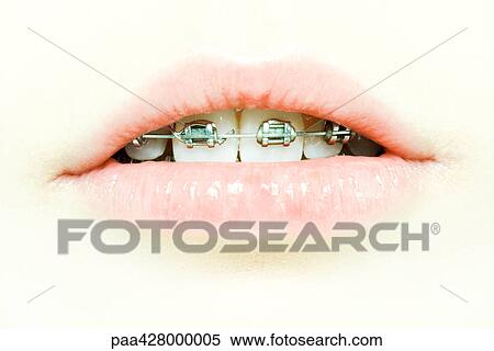 Stock Photography - Teenage girl's mouth with braces, extreme close-up. Fotosearch