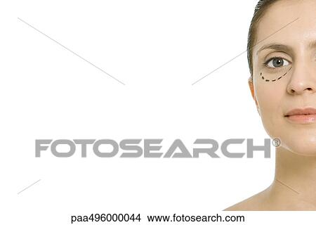 Woman with plastic surgery markings under eye, looking at camera, cropped View Large Photo Image Picture - Woman with plastic surgery markings under eye, looking at camera, cropped. Fotosearch