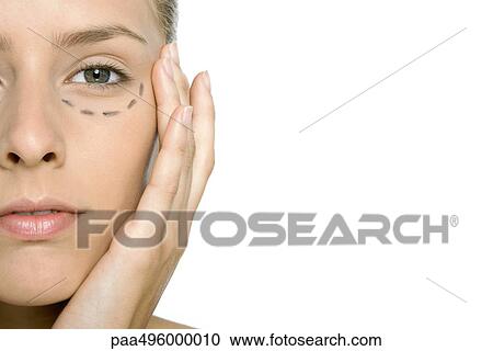 Woman with plastic surgery markings under her eye, close-up, cropped View Large Photo Image Stock Image - Woman with plastic surgery markings under her eye, close-up, cropped. Fotosearch