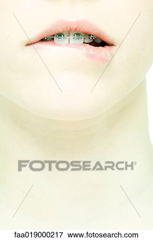 Teenage girl with braces biting lip, extreme close-up View Large Photo Image Stock Photo - Teenage girl with braces biting lip, extreme close-up. Fotosearch