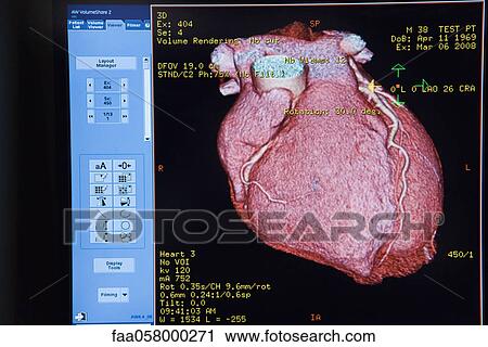 Computer monitor displaying CAT scan image of heart View Large Photo Image Stock Image - Computer monitor displaying CAT scan image of heart. Fotosearch