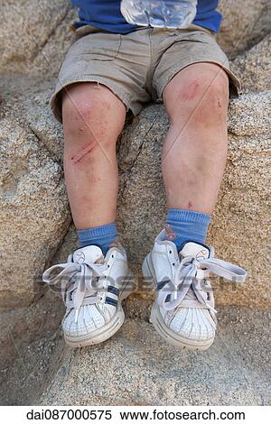 Child's scraped legs View Large Photo Image Stock Photography - Child's scraped legs. Fotosearch