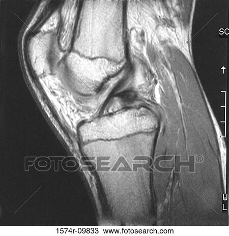 Stock Image - Scan of a human knee. Fotosearch