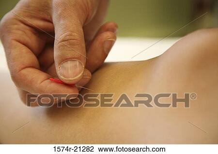 Stock Image - Close-up of a person getting an acupuncture treatment. Fotosearch
