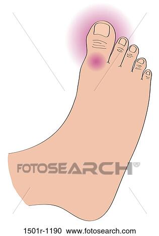 Close-up of foot with gout View Large Photo Image Stock Image - Close-up of foot with gout. Fotosearch