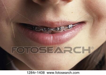 Close-up of a girl with braces View Large Photo Image Stock Photo - Close-up of a girl with braces. Fotosearch