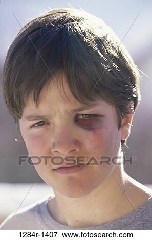 Portrait of a boy with a bruised eye View Large Photo Image Stock Photo - Portrait of a boy with a bruised eye. Fotosearch
