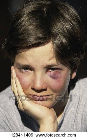 Stock Photograph - Portrait of a boy with a bruised eye. Fotosearch