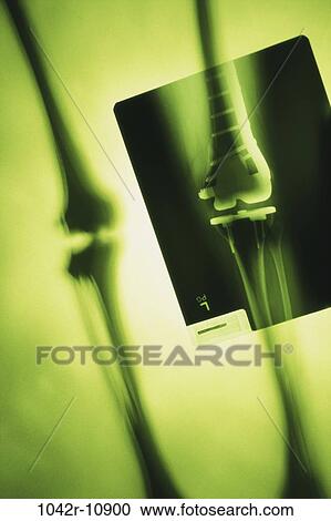 X-ray of a human leg with metal screws and rods View Large Photo Image Stock Image - X-ray of a human leg with metal screws and rods. Fotosearch