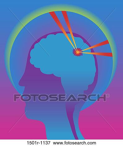 Stock Photo - Gamma Knife, illustration. Fotosearch