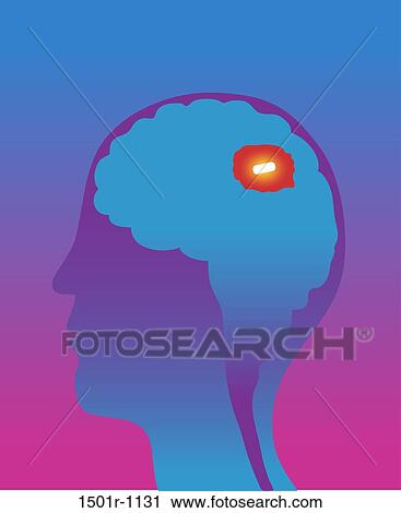 Stock Image - Man's brain with mental pill inside, cross section, illustration. Fotosearch