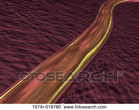 Artery showing Atheroma View Large Illustration Clipart - Artery showing Atheroma. Fotosearch